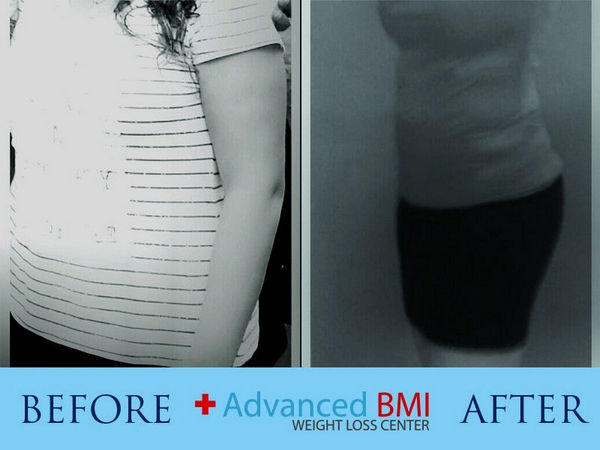 Weight Loss Surgery Before And After Advanced Bmi Lebanon Dr Nagi Jean Safa Clinic 6286