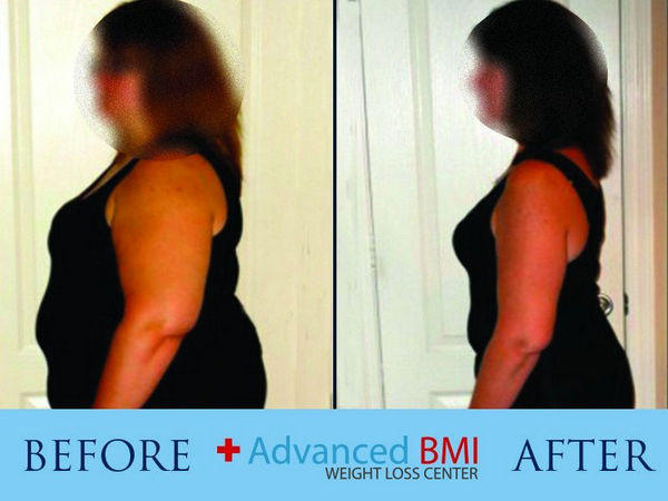 Weight Loss Surgery Before And After Advanced Bmi Lebanon Dr Nagi Jean Safa Clinic 