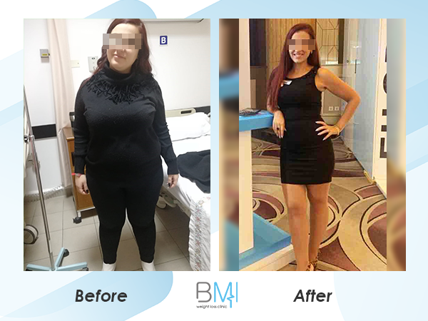 Weight Loss Surgery Before And After Advanced Bmi Lebanon Dr Nagi